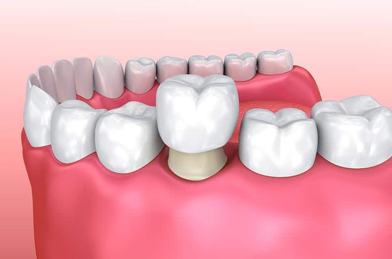 Tips for Maintaining Your Dental Crowns