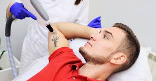 What You Need To Know About Laser Tattoo Removal