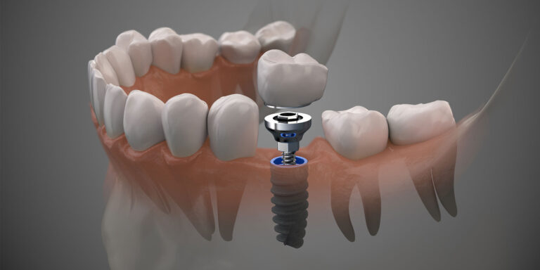 When To Ask Your Dentist About Dental Implants