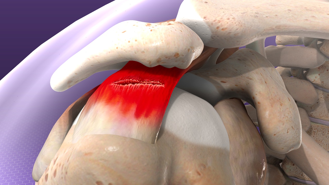 Understanding the Symptoms and Treatment Options for a Rotator Cuff Tear