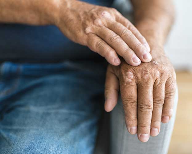 Exploring the Role of Biologics in Psoriatic Arthritis Treatment