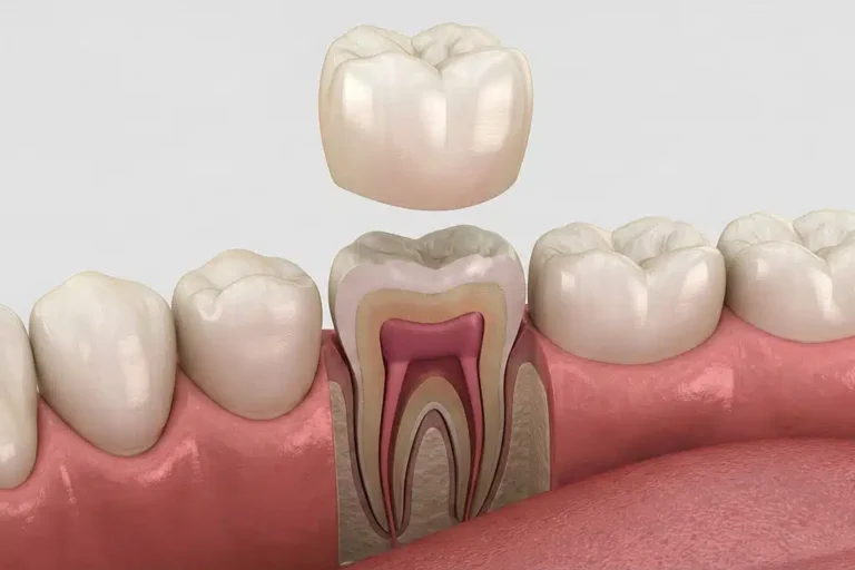 Materials and Techniques Used for Dental Crowns