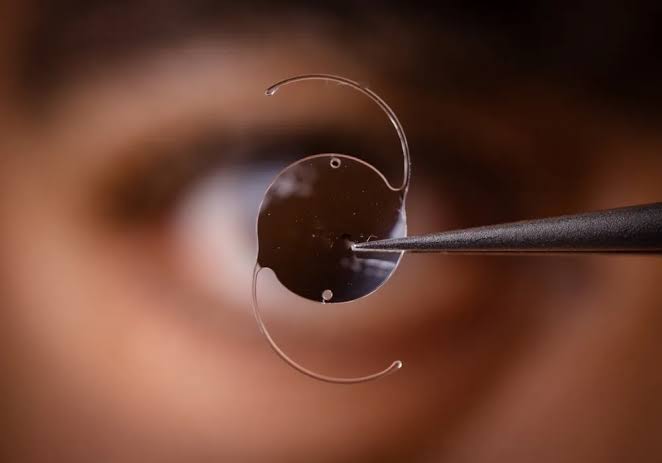 The Benefits of Follow-Up Visits After Cataract Surgery