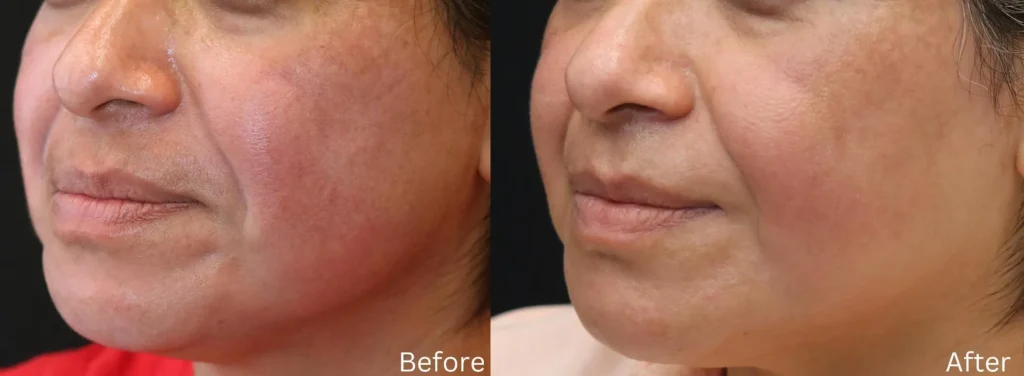 Unveiling the Facts About Mohs Surgery