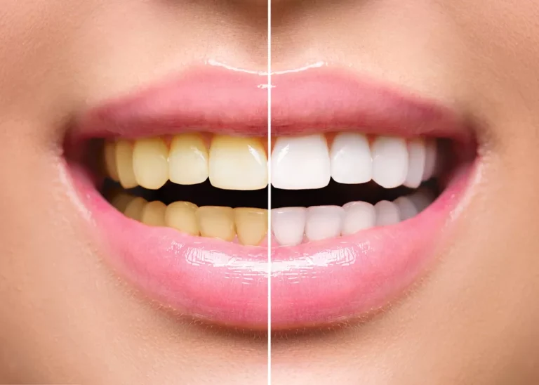 What Are the Benefits of Cosmetic Dentistry?