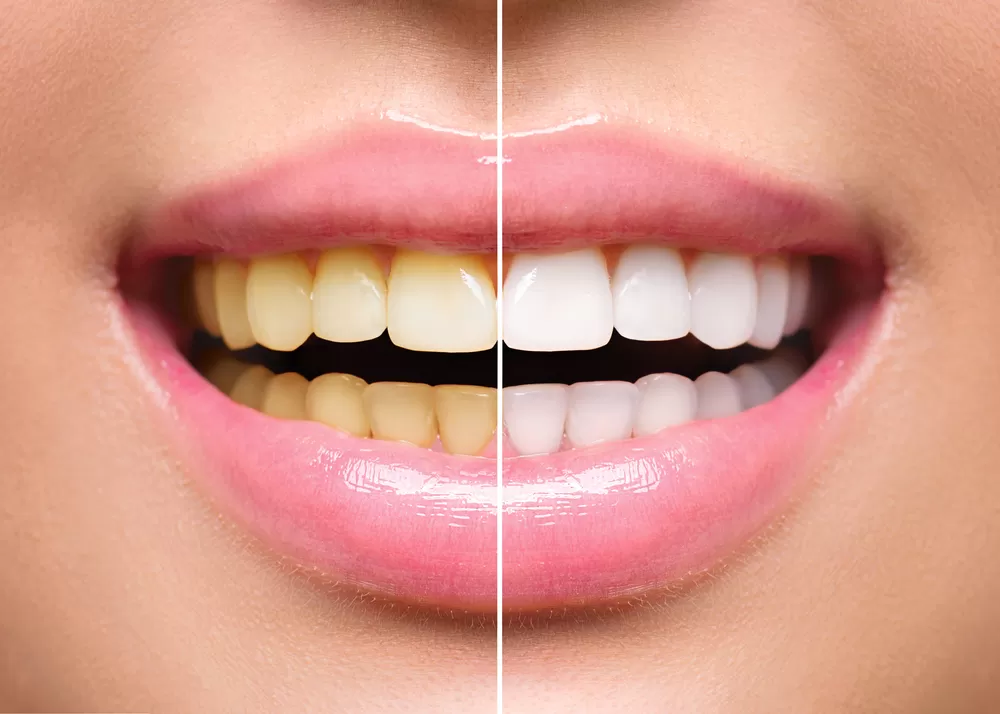 What Are the Benefits of Cosmetic Dentistry?